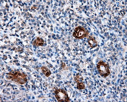 L1CAM Antibody - IHC of paraffin-embedded Carcinoma of thyroid tissue using anti-L1CAM mouse monoclonal antibody. (Dilution 1:50).