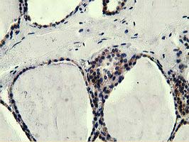 L1CAM Antibody - Immunohistochemical staining of paraffin-embedded Human thyroid tissue using anti-L1CAM mouse monoclonal antibody.