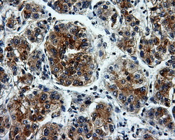 L1CAM Antibody - Immunohistochemical staining of paraffin-embedded Carcinoma of liver tissue using anti-L1CAM mouse monoclonal antibody. (Dilution 1:50).