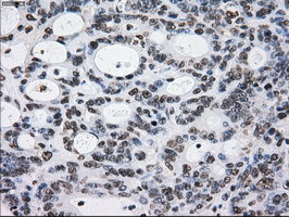 L1CAM Antibody - IHC of paraffin-embedded Adenocarcinoma of colon tissue using anti-L1CAM mouse monoclonal antibody. (Dilution 1:50).