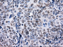 L1CAM Antibody - IHC of paraffin-embedded Adenocarcinoma of ovary tissue using anti-L1CAM mouse monoclonal antibody. (Dilution 1:50).
