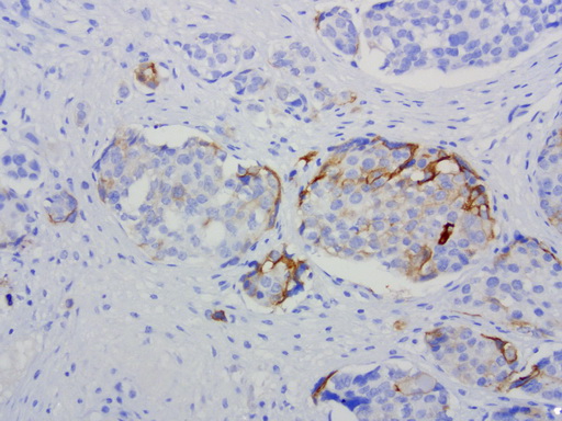 L1CAM Antibody - Immunohistochemical staining of paraffin-embedded human ovcarian carcinoma using anti-L1CAM clone UMAB47 mouse monoclonal antibody at 1:200 with Polink2 Broad HRP DAB detection kit ; heat-induced epitope retrieval with citrate buffer, pH6.0at 95-100C. Cytoplasmic and membraneous staining is seen in tumor cells.