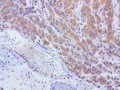 L1CAM Antibody - Immunohistochemical staining of paraffin-embedded human melanoma using anti-L1CAM clone UMAB47 mouse monoclonal antibody  at 1:200 with Polink2 Broad HRP DAB detection kit; heat-induced epitope retrieval with GBI ACCEL HIER buffer using pressure chamber for 3 minutes at 110C. Cytoplasmic staining seen in staining in tumor cells.