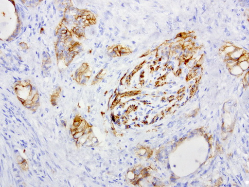 L1CAM Antibody - Immunohistochemical staining of paraffin-embedded human colon cancer using anti-L1CAM clone UMAB48 mouse monoclonal antibody  at 1:200 with Polink2 Broad HRP DAB detection kit; heat-induced epitope retrieval with GBI ACCEL HIER buffer using pressure chamber for 3 minutes at 110C. Image shows tumor cells with positive cytoplasmic and membraneous stain.
