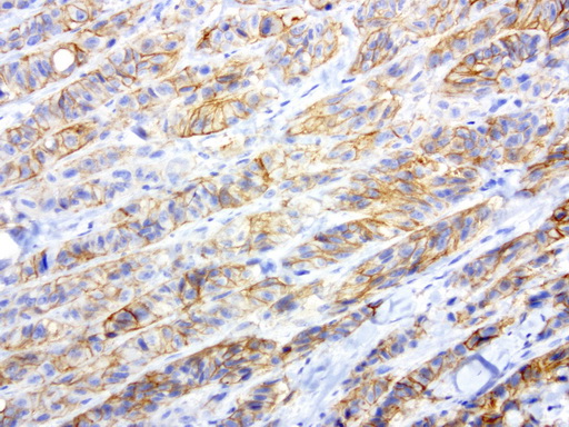 L1CAM Antibody - Immunohistochemical staining of paraffin-embedded human melanoma using anti-L1CAM clone UMAB48 mouse monoclonal antibody  at 1:200 with Polink2 Broad HRP DAB detection kit; heat-induced epitope retrieval with GBI ACCEL HIER buffer using pressure chamber for 3 minutes at 110C. Image shows strong positive membraneous and cytoplasmic staining in the tumor cells.