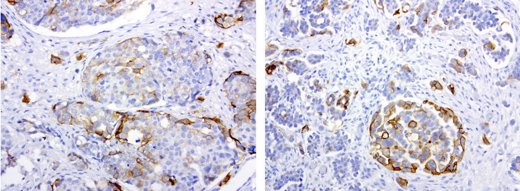 L1CAM Antibody - Immunohistochemical staining of paraffin-embedded human ovarian carcinoma using anti-L1CAM clone UMAB48 mouse monoclonal antibody  at 1:200 with Polink2 Broad HRP DAB detection kit; heat-induced epitope retrieval with GBI ACCEL HIER buffer using pressure chamber for 3 minutes at 110C. Image shows positive cytoplasmic and membraneous stain in a subset of the tumor cells.