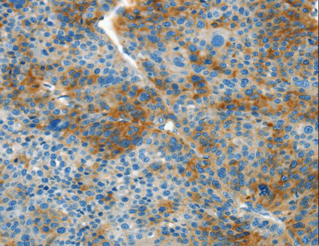 L1CAM Antibody - Immunohistochemistry of paraffin-embedded Human thyroid cancer using L1CAM Polyclonal Antibody at dilution of 1:40.