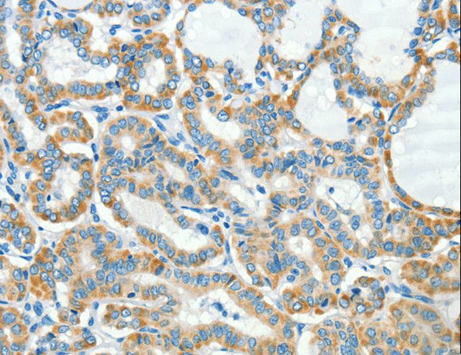 L1CAM Antibody - Immunohistochemistry of paraffin-embedded Human thyroid cancer using L1CAM Polyclonal Antibody at dilution of 1:40.