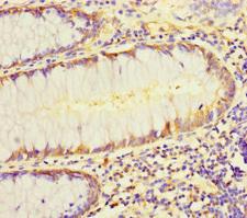 L1TD1 Antibody - Immunohistochemistry of paraffin-embedded human colon cancer using L1TD1 Antibody at dilution of 1:100