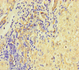 L1TD1 Antibody - Immunohistochemistry of paraffin-embedded human liver cancer using L1TD1 Antibody at dilution of 1:100