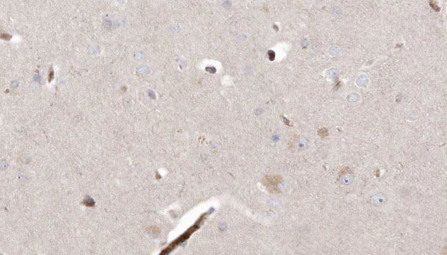 L2HGDH Antibody - 1:100 staining human brain carcinoma tissue by IHC-P. The sample was formaldehyde fixed and a heat mediated antigen retrieval step in citrate buffer was performed. The sample was then blocked and incubated with the antibody for 1.5 hours at 22°C. An HRP conjugated goat anti-rabbit antibody was used as the secondary.