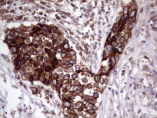 L3 / LASS2 Antibody - Immunohistochemical staining of paraffin-embedded Carcinoma of Human lung tissue using anti-CERS2 mouse monoclonal antibody. (Heat-induced epitope retrieval by 1mM EDTA in 10mM Tris buffer. (pH8.5) at 120°C for 3 min. (1:1000)