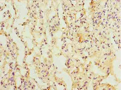 L3HYPDH / C14orf149 Antibody - Immunohistochemistry of paraffin-embedded human lung cancer using L3HYPDH Antibody at dilution of 1:100