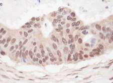 L3MBTL2 Antibody - Detection of Human L3MBTL2 by Immunohistochemistry. Sample: FFPE section of human ovarian carcinoma. Antibody: Affinity purified rabbit anti-L3MBTL2 used at a dilution of 1:1000 (1 Detection: Vector ImmPACT NovaRED.