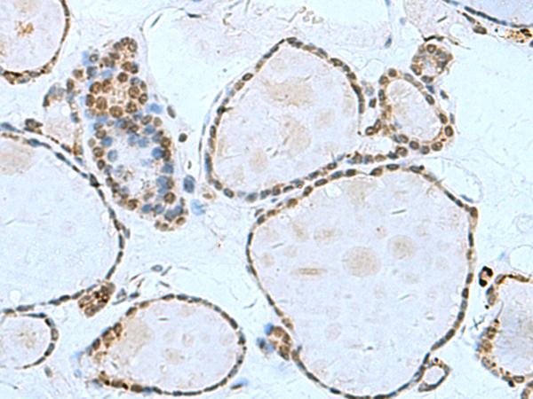 L3MBTL2 Antibody - Immunohistochemistry of paraffin-embedded Human thyroid cancer tissue  using L3MBTL2 Polyclonal Antibody at dilution of 1:70(×200)