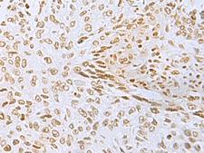 L3MBTL2 Antibody - Immunohistochemistry of paraffin-embedded Human lung cancer tissue  using L3MBTL2 Polyclonal Antibody at dilution of 1:60(×200)