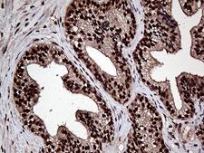 L3MBTL3 Antibody - Immunohistochemical staining of paraffin-embedded Carcinoma of Human prostate tissue using anti-L3MBTL3 mouse monoclonal antibody. (Heat-induced epitope retrieval by 1mM EDTA in 10mM Tris buffer. (pH8.5) at 120°C for 3 min. (1:1000)