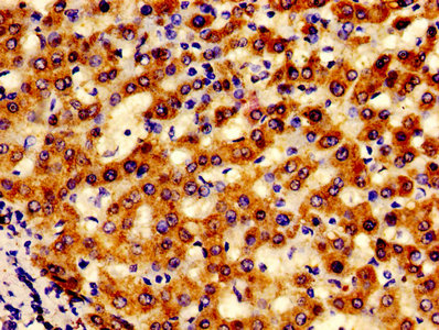 LACE1 Antibody - IHC image of LACE1 Antibody diluted at 1:600 and staining in paraffin-embedded human liver cancer performed on a Leica BondTM system. After dewaxing and hydration, antigen retrieval was mediated by high pressure in a citrate buffer (pH 6.0). Section was blocked with 10% normal goat serum 30min at RT. Then primary antibody (1% BSA) was incubated at 4°C overnight. The primary is detected by a biotinylated secondary antibody and visualized using an HRP conjugated SP system.