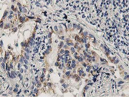 LACTB2 Antibody - IHC of paraffin-embedded Carcinoma of Human lung tissue using anti-LACTB2 mouse monoclonal antibody. (Heat-induced epitope retrieval by 10mM citric buffer, pH6.0, 100C for 10min).