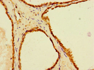 LACTB2 Antibody - Immunohistochemistry of paraffin-embedded human prostate cancerLACTB2 Antibody