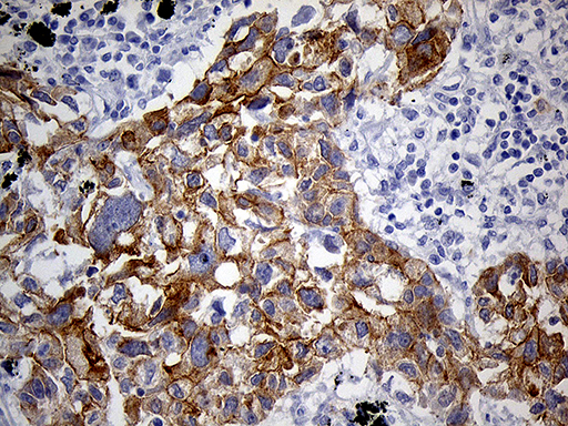 LAD1 Antibody - Immunohistochemical staining of paraffin-embedded Carcinoma of Human lung tissue using anti-LAD1 mouse monoclonal antibody. (Heat-induced epitope retrieval by 1mM EDTA in 10mM Tris buffer. (pH8.5) at 120°C for 3 min. (1:500)