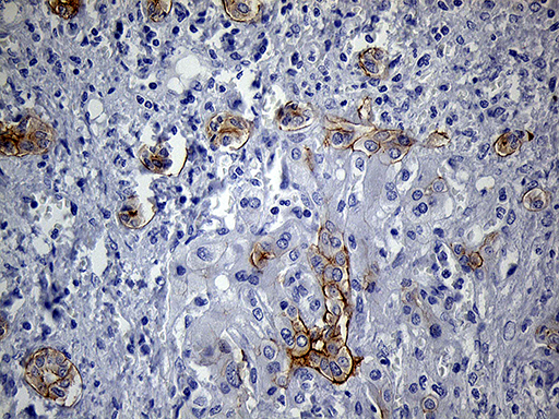 LAD1 Antibody - Immunohistochemical staining of paraffin-embedded Carcinoma of Human liver tissue using anti-LAD1 mouse monoclonal antibody. (Heat-induced epitope retrieval by 1mM EDTA in 10mM Tris buffer. (pH8.5) at 120°C for 3 min. (1:500)