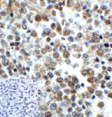 LAG3 Antibody - Immunohistochemistry of LAG-3 in human lymphoma tissue using LAG-3 Antibody and control mouse IgG (corner box) at 5 ug/ml.