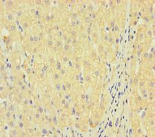 LAIR2 / CD306 Antibody - Immunohistochemistry of paraffin-embedded human liver cancer using LAIR2 Antibody at dilution of 1:100