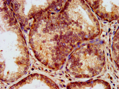 LAMA2 / Merosin Antibody - Immunohistochemistry image at a dilution of 1:200 and staining in paraffin-embedded human prostate cancer performed on a Leica BondTM system. After dewaxing and hydration, antigen retrieval was mediated by high pressure in a citrate buffer (pH 6.0) . Section was blocked with 10% normal goat serum 30min at RT. Then primary antibody (1% BSA) was incubated at 4 °C overnight. The primary is detected by a biotinylated secondary antibody and visualized using an HRP conjugated SP system.