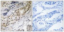 LAMA3 / Laminin Alpha 3 Antibody - Immunohistochemistry analysis of paraffin-embedded human colon carcinoma tissue, using LAMA3 Antibody. The picture on the right is blocked with the synthesized peptide.