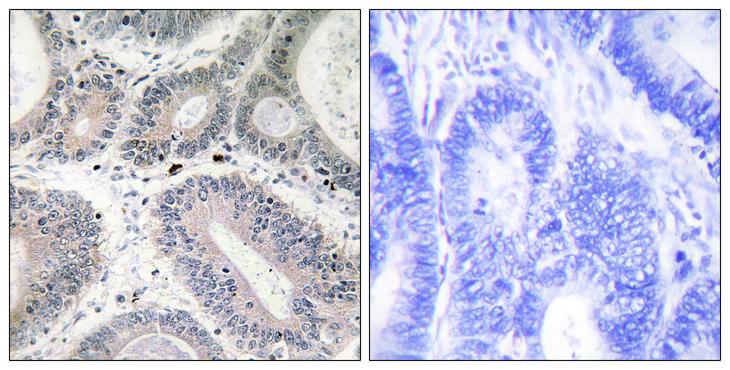 LAMA3 / Laminin Alpha 3 Antibody - Peptide - + Immunohistochemistry analysis of paraffin-embedded human colon carcinoma tissue using LAMA3 antibody.