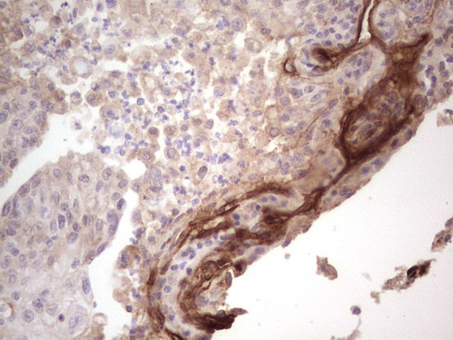LAMA4 / Laminin Alpha 4 Antibody - Immunohistochemical staining of paraffin-embedded Carcinoma of Human lung tissue using anti-LAMA4 mouse monoclonal antibody.  heat-induced epitope retrieval by 1 mM EDTA in 10mM Tris, pH8.5, 120C for 3min)