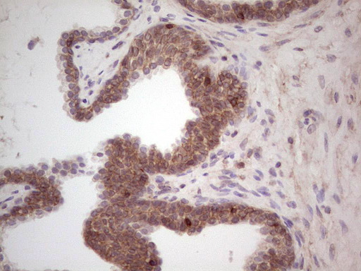 LAMA4 / Laminin Alpha 4 Antibody - Immunohistochemical staining of paraffin-embedded Carcinoma of Human prostate tissue using anti-LAMA4 mouse monoclonal antibody.  heat-induced epitope retrieval by 1 mM EDTA in 10mM Tris, pH8.5, 120C for 3min)