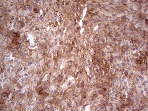 LAMA4 / Laminin Alpha 4 Antibody - Immunohistochemical staining of paraffin-embedded Human lymph node tissue within the normal limits using anti-LAMA4 mouse monoclonal antibody.  heat-induced epitope retrieval by 1 mM EDTA in 10mM Tris, pH8.5, 120C for 3min)