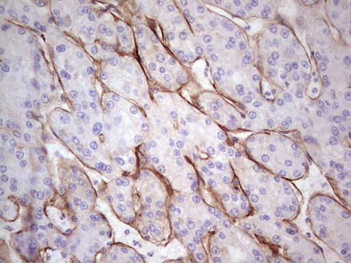 LAMA4 / Laminin Alpha 4 Antibody - Immunohistochemical staining of paraffin-embedded Carcinoma of Human liver tissue using anti-LAMA4 mouse monoclonal antibody.  heat-induced epitope retrieval by 1 mM EDTA in 10mM Tris, pH8.5, 120C for 3min)