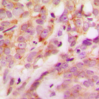 LAMA4 / Laminin Alpha 4 Antibody - Immunohistochemical analysis of Laminin alpha 4 staining in human breast cancer formalin fixed paraffin embedded tissue section. The section was pre-treated using heat mediated antigen retrieval with sodium citrate buffer (pH 6.0). The section was then incubated with the antibody at room temperature and detected using an HRP conjugated compact polymer system. DAB was used as the chromogen. The section was then counterstained with hematoxylin and mounted with DPX.