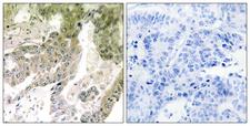 LAMA5 / Laminin Alpha 5 Antibody - Immunohistochemistry analysis of paraffin-embedded human lung carcinoma tissue, using LAMA5 Antibody. The picture on the right is blocked with the synthesized peptide.