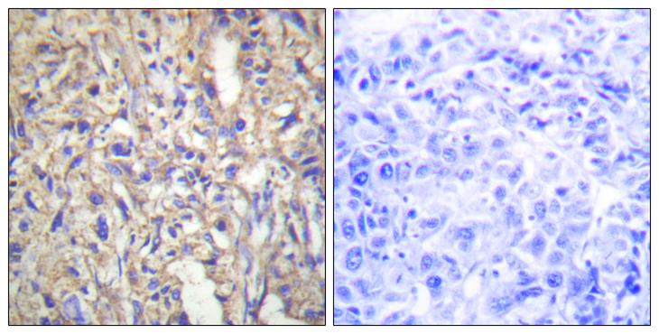 LAMB1 / Laminin Beta 1 Antibody - Peptide - + Immunohistochemistry analysis of paraffin-embedded human liver carcinoma tissue using LAMB1 antibody.