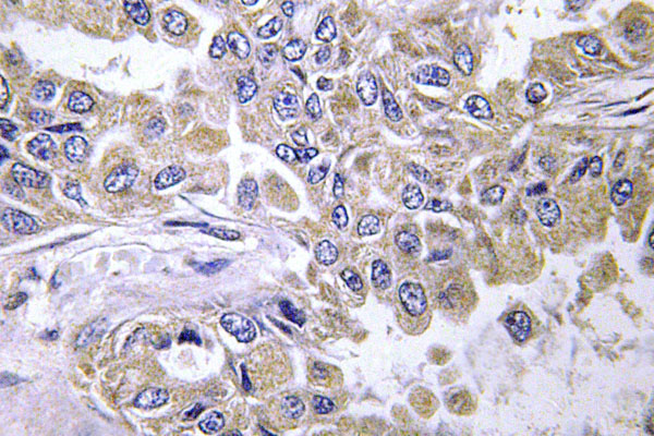 LAMB2 / Laminin Beta 2 Antibody - IHC of Laminin -2 (C91) pAb in human paraffin-embedded lung carcinoma tissue.