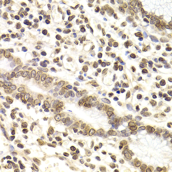 LAMB2 / Laminin Beta 2 Antibody - Immunohistochemistry of paraffin-embedded human gastric carcinoma tissue.