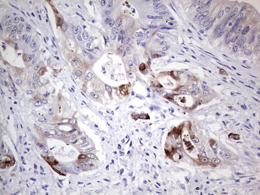 LAMB3 / Laminin Beta 3 Antibody - IHC of paraffin-embedded Adenocarcinoma of Human colon tissue using anti-LAMB3 mouse monoclonal antibody. (Heat-induced epitope retrieval by 1 mM EDTA in 10mM Tris, pH8.5, 120°C for 3min).