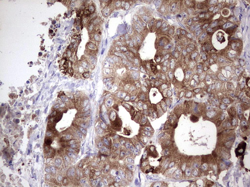 LAMB3 / Laminin Beta 3 Antibody - Immunohistochemical staining of paraffin-embedded Adenocarcinoma of Human colon tissue using anti-LAMB3 mouse monoclonal antibody. (Heat-induced epitope retrieval by 1 mM EDTA in 10mM Tris, pH8.5, 120C for 3min,