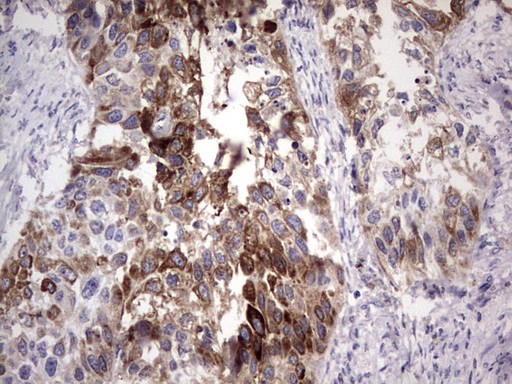 LAMB3 / Laminin Beta 3 Antibody - IHC of paraffin-embedded Carcinoma of Human kidney tissue using anti-LAMB3 mouse monoclonal antibody. (Heat-induced epitope retrieval by 1 mM EDTA in 10mM Tris, pH8.5, 120°C for 3min).