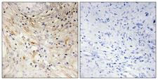 LAMB3 / Laminin Beta 3 Antibody - Immunohistochemistry analysis of paraffin-embedded human prostate carcinoma tissue, using LAMB3 Antibody. The picture on the right is blocked with the synthesized peptide.