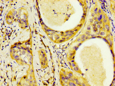 LAMB3 / Laminin Beta 3 Antibody - Immunohistochemistry image at a dilution of 1:300 and staining in paraffin-embedded human cervical cancer performed on a Leica BondTM system. After dewaxing and hydration, antigen retrieval was mediated by high pressure in a citrate buffer (pH 6.0) . Section was blocked with 10% normal goat serum 30min at RT. Then primary antibody (1% BSA) was incubated at 4 °C overnight. The primary is detected by a biotinylated secondary antibody and visualized using an HRP conjugated SP system.