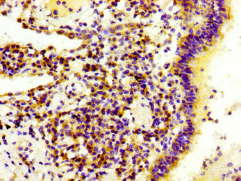 LAMB3 / Laminin Beta 3 Antibody - Immunohistochemistry image at a dilution of 1:300 and staining in paraffin-embedded human lung cancer performed on a Leica BondTM system. After dewaxing and hydration, antigen retrieval was mediated by high pressure in a citrate buffer (pH 6.0) . Section was blocked with 10% normal goat serum 30min at RT. Then primary antibody (1% BSA) was incubated at 4 °C overnight. The primary is detected by a biotinylated secondary antibody and visualized using an HRP conjugated SP system.
