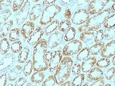 LAMC1 / Laminin Gamma 1 Antibody - Formalin-fixed, paraffin-embedded human renal cell carcinoma stained with Laminin gamma 1 antibody (A5).  This image was taken for the unmodified form of this product. Other forms have not been tested.
