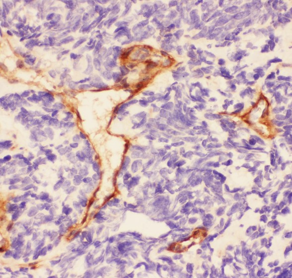 LAMC1 / Laminin Gamma 1 Antibody - Laminin antibody IHC-paraffin: Human Lung Cancer Tissue.