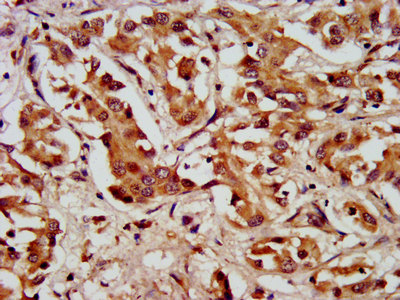LAMC2 / Laminin Gamma 2 Antibody - Immunohistochemistry image at a dilution of 1:200 and staining in paraffin-embedded human liver cancer performed on a Leica BondTM system. After dewaxing and hydration, antigen retrieval was mediated by high pressure in a citrate buffer (pH 6.0) . Section was blocked with 10% normal goat serum 30min at RT. Then primary antibody (1% BSA) was incubated at 4 °C overnight. The primary is detected by a biotinylated secondary antibody and visualized using an HRP conjugated SP system.