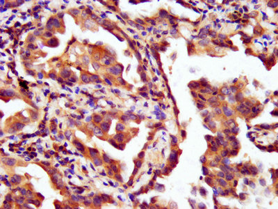 LAMC2 / Laminin Gamma 2 Antibody - Immunohistochemistry image at a dilution of 1:200 and staining in paraffin-embedded human lung cancer performed on a Leica BondTM system. After dewaxing and hydration, antigen retrieval was mediated by high pressure in a citrate buffer (pH 6.0) . Section was blocked with 10% normal goat serum 30min at RT. Then primary antibody (1% BSA) was incubated at 4 °C overnight. The primary is detected by a biotinylated secondary antibody and visualized using an HRP conjugated SP system.